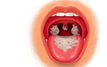 دیفتری چیست؟ | هر آنچه باید در مورد دیفتری بدانید

