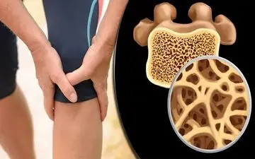 وقتی استخوان‌ها بی‌صدا می‌شکنند!/ راهکارهایی ساده برای پیشگیری از پوکی استخوان