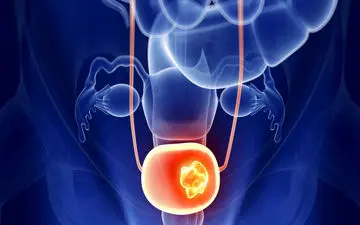 چگونه با تغییرات سبک زندگی از سرطان مثانه پیشگیری کنیم؟