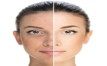 چند راهکار برای محافظت از پوست در فصل سرما