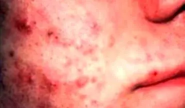 استرس چگونه باعث کهیر یا بثورات پوستی می‌شود؟