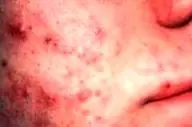 استرس چگونه باعث کهیر یا بثورات پوستی می‌شود؟