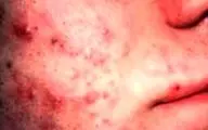 استرس چگونه باعث کهیر یا بثورات پوستی می‌شود؟