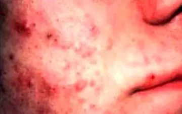 استرس چگونه باعث کهیر یا بثورات پوستی می‌شود؟