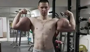 پایان دردناک شهرت با سینتول؛ «ملوان‌زبل روسی» در آستانه از دست دادن دست‌هایش