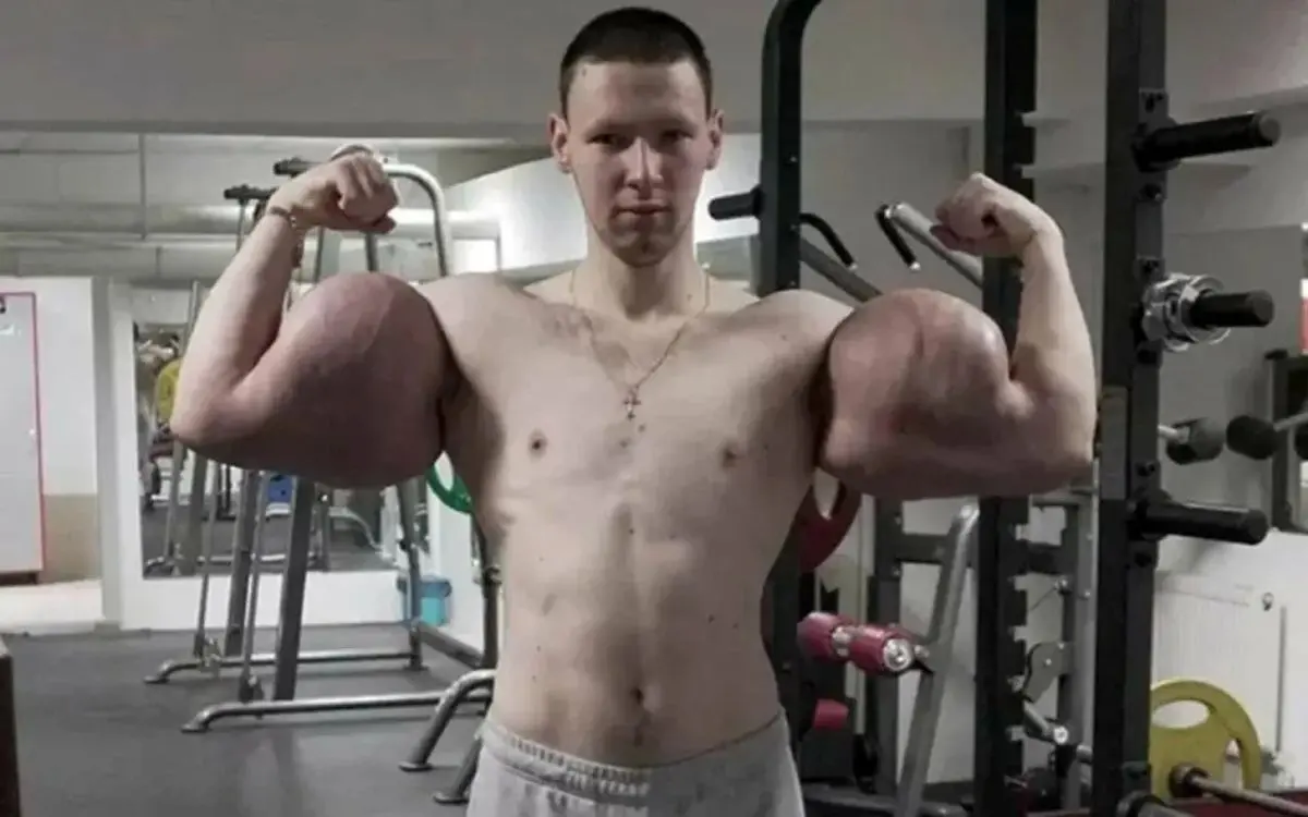 پایان دردناک شهرت با سینتول؛ «ملوان‌زبل روسی» در آستانه از دست دادن دست‌هایش