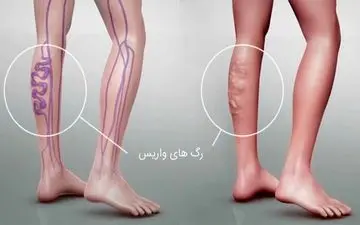 درمان های خانگی برای واریس