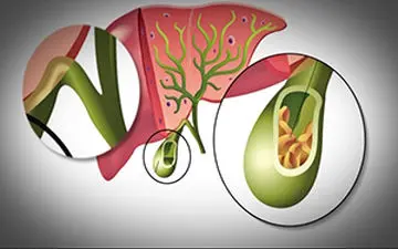 خطر ابتلا به سنگ کیسه صفرا در کمین افرادی که رژیم می‌گیرند +فیلم