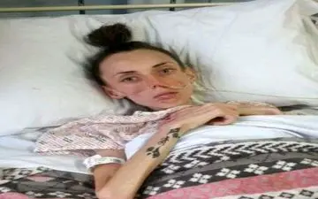 بیماری عجیبی که دختر سنگین وزن را به اسکلت شبیه کرد +عکس