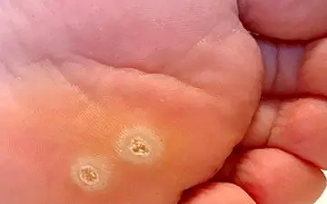 میخچه داری و اذیتت میکنه؟ بیا تا بهت بگم چطور درمانش کنی!