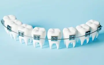 مراقبت از دندان ها و لثه ها در طول درمان ارتودنسی