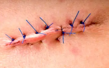 بخیه زدن زخم‌های سطحی با ابتکار جدید + فیلم