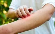 چگونگی جلوگیری از خارش و التهاب پوستی در فصل بهار

