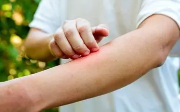 چگونگی جلوگیری از خارش و التهاب پوستی در فصل بهار

