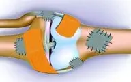 علل اصلی کاهش کاهش تراکم استخوان