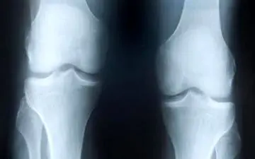 روزی چند قدم راه برویم تا آرتروز زانو درمان شود؟