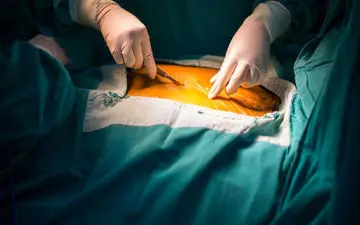 عمل بای پس معده چگونه انجام می‌شود؟