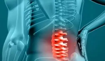 این عوامل باعث ابتلای شما به دیسک کمر می‌شوند