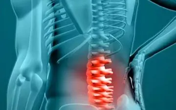 این عوامل باعث ابتلای شما به دیسک کمر می‌شوند