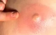 در مورد جوش روی کمر چه میدانید؟
