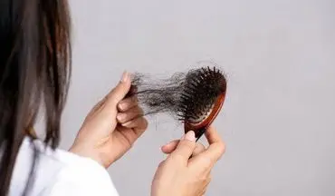 درمان ریزش مو و چند روش جدید