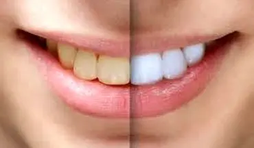 معایب سفید کردن دندان به صورت شیمیایی