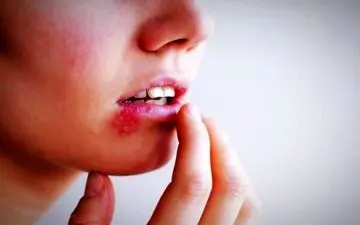 خداحافظی با تبخال لب: 32 درمان گیاهی سریع و موثر