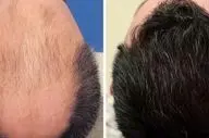 آیا کاشت مو برای همیشه می‌ماند یا دوباره می‌ریزد؟