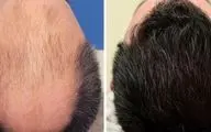 آیا کاشت مو برای همیشه می‌ماند یا دوباره می‌ریزد؟