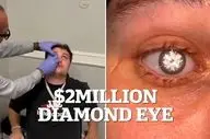 چشم مصنوعی با الماس ۲ قیراطی مردی که شبیه شرورهای جیمز باند است!