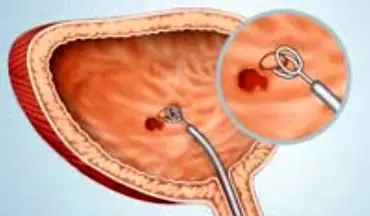 اگر مشکل مثانه دارید حتما این مطلب را بخوانید!