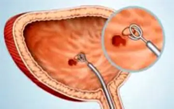 اگر مشکل مثانه دارید حتما این مطلب را بخوانید!