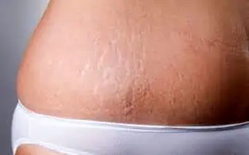 طبیعی ترین راه از بین بردن ترک های شکم بعد از زایمان