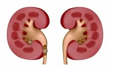 بخور و نخورها در سنگ کلیه/10 موردی که باید بدانید 