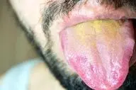 چرا زبانتان زرد می‌شود؟/ رازهایی که هیچ پزشکی نگفته است