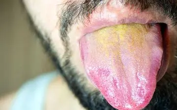 چرا زبانتان زرد می‌شود؟/ رازهایی که هیچ پزشکی نگفته است