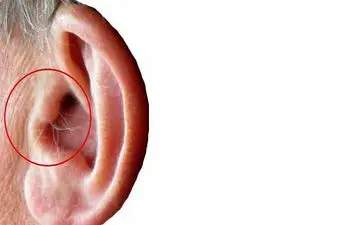  هشدار جدی؛ موی گوش «نشانه قاتل خاموش» است!