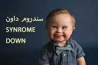 تشخیص زود هنگام  سندرم داون  با این روش!