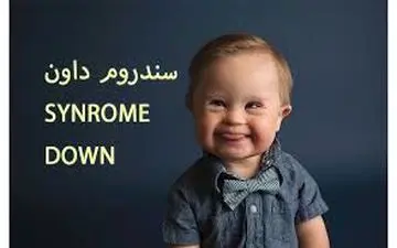تشخیص زود هنگام  سندرم داون  با این روش!
