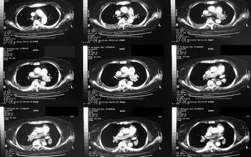 سی تی اسکن موجب افزایش ریسک این بیماری می شود