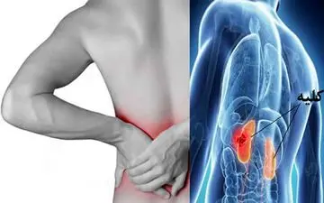 عفونت کلیه و هر آنچه که باید در مورد آن بدانید