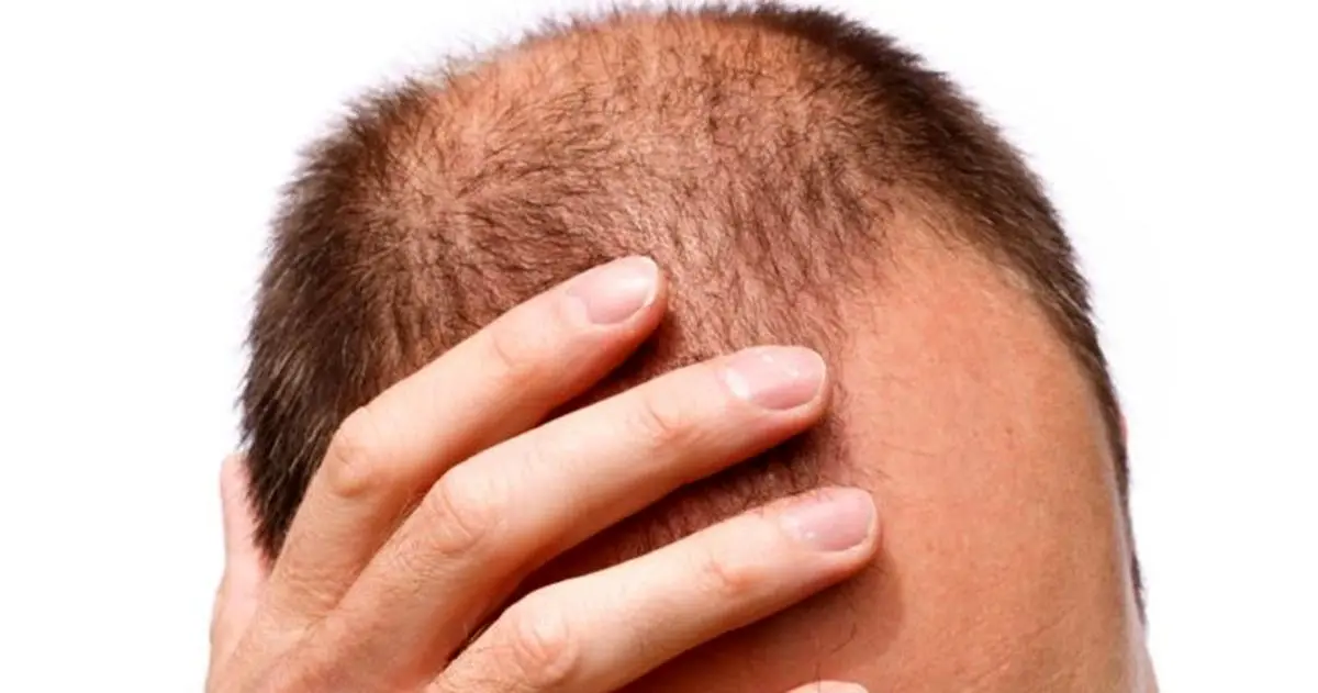 چگونه از ریزش مو در آقایان جلوگیری شود؟