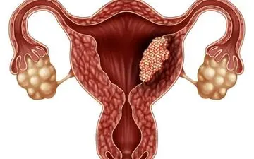 خطر ابتلا به سرطان دیگر در مبتلایان به سرطان دهانه رحم درمان شده!