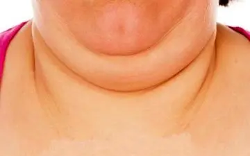  چگونه چربی گردن را از بین ببریم؟