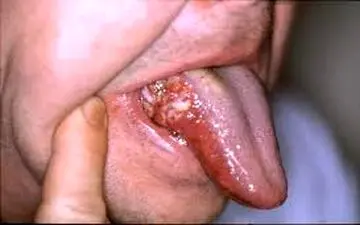 دلیل سرطان دهان چیست؟