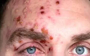 تغذیه ناسالم و بلایی که بر سر پوست می آورد!