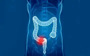 نقش استرس و کم‌ خوابی در پیشرفت این سرطان 
