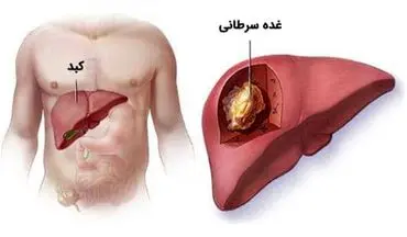 علائم و درمان سرطان کبد