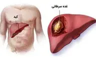 علائم و درمان سرطان کبد