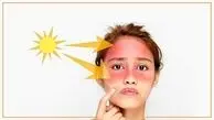 ریسک آفتاب سوختگی با مصرف این نوع داروها بیشتر می شود